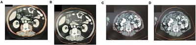 Impact of Sarcopenia on Functional and Oncological Outcomes After Radical Prostatectomy